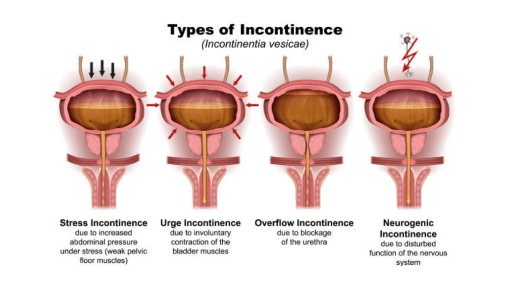 Urinary incontinence 
urinary system